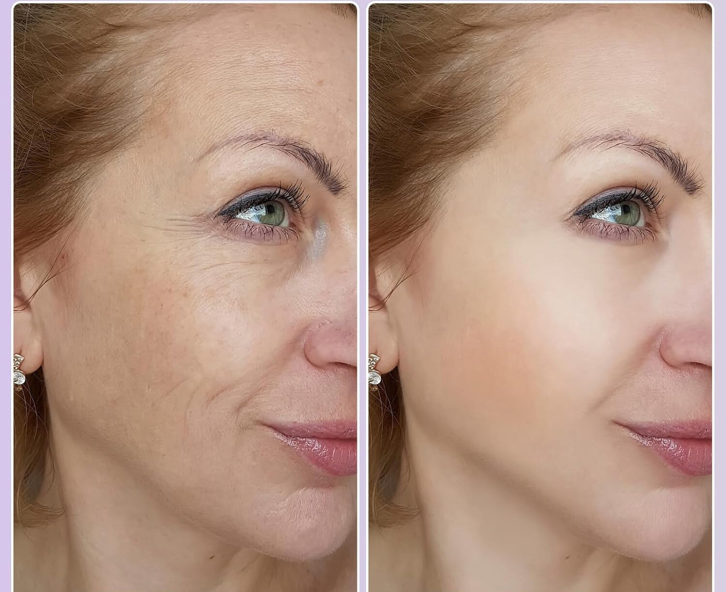 MICRO NEEDLING ANTI VEROUDERINGS SERUM
